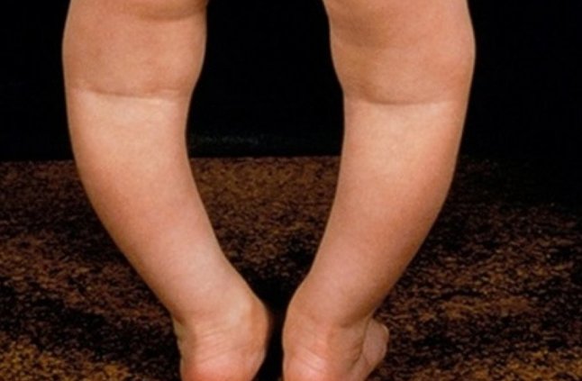 علاج تقوس الساقين للداخل عند الاطفال