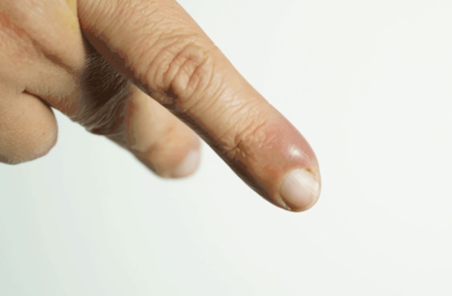 علاج الاصبع المدوحس ومعلومات هامة صحة